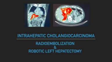 Colangiocarcinoma intrahepático y Radioembolización                                      Hepatectomía Izquierda Robótica